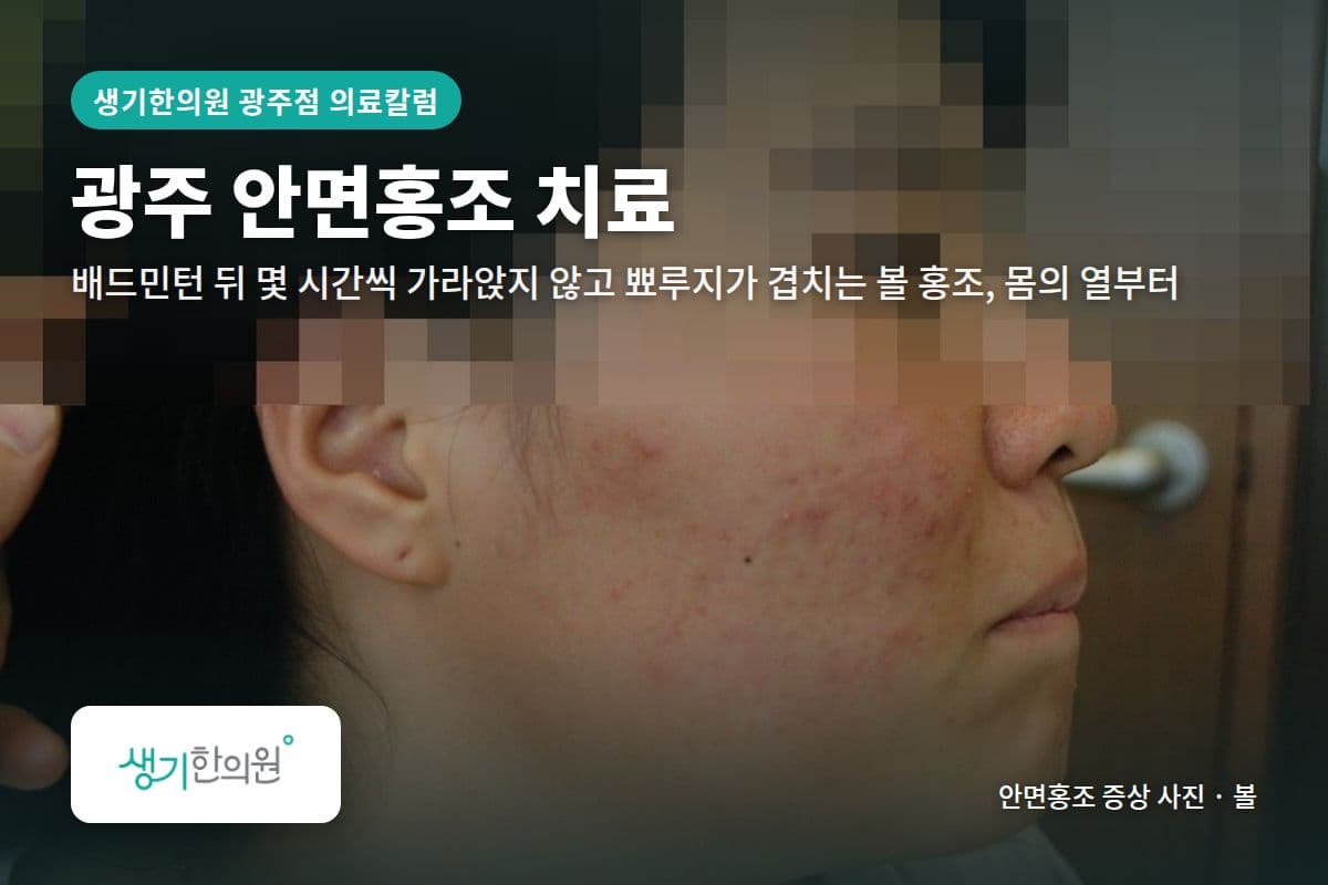 볼 안면홍조 증상 사진과 문구 「광주 안면홍조 치료, 배드민턴 뒤 몇 시간씩 가라앉지 않고 뾰루지가 겹치는 볼 홍조, 몸의 열부터 · 생기한의원 광주점」