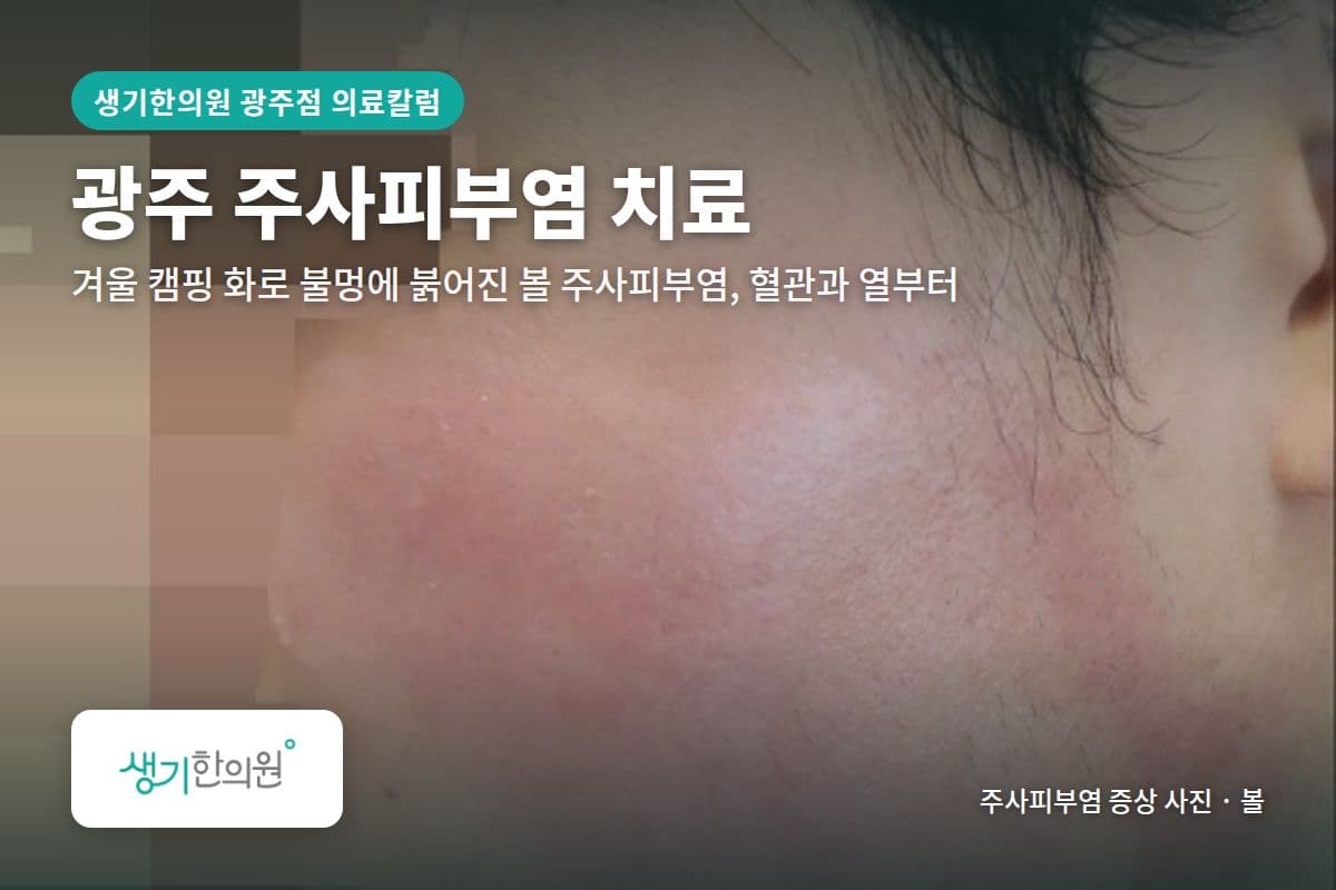 볼 주사피부염 증상 사진과 문구 「광주 주사피부염 치료, 겨울 캠핑 화로 불멍에 붉어진 볼 주사피부염, 혈관과 열부터 · 생기한의원 광주점」